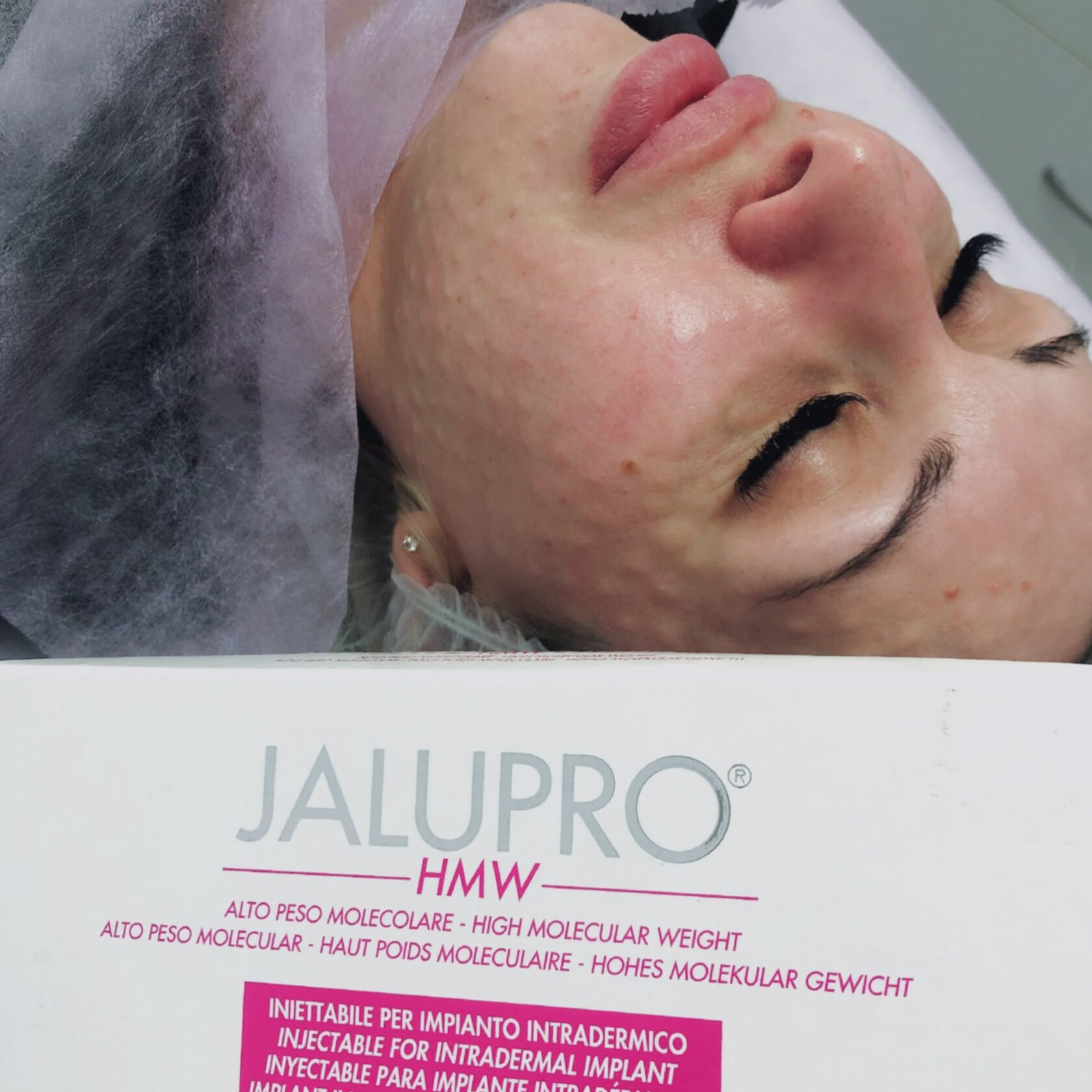 Биоревитализация препаратом Jalupro