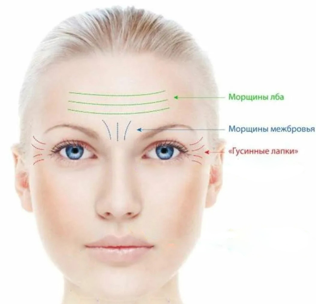 Botox/Диспорт/Xeomin/Релатокс Верхняя треть лица + крольчачий носик или крылья носа (на выбор) — Акции и скидки в Казани