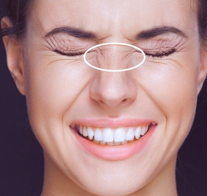 Botox/Диспорт/Xeomin/Релатокс «Крольчачий носик» «под ключ» - докоррекция бесплатно — Ботулинотерапия в Казани